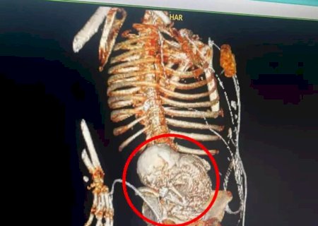 “Grávida por 5 décadas”: paciente descobre feto mumificado há 56 anos na barriga